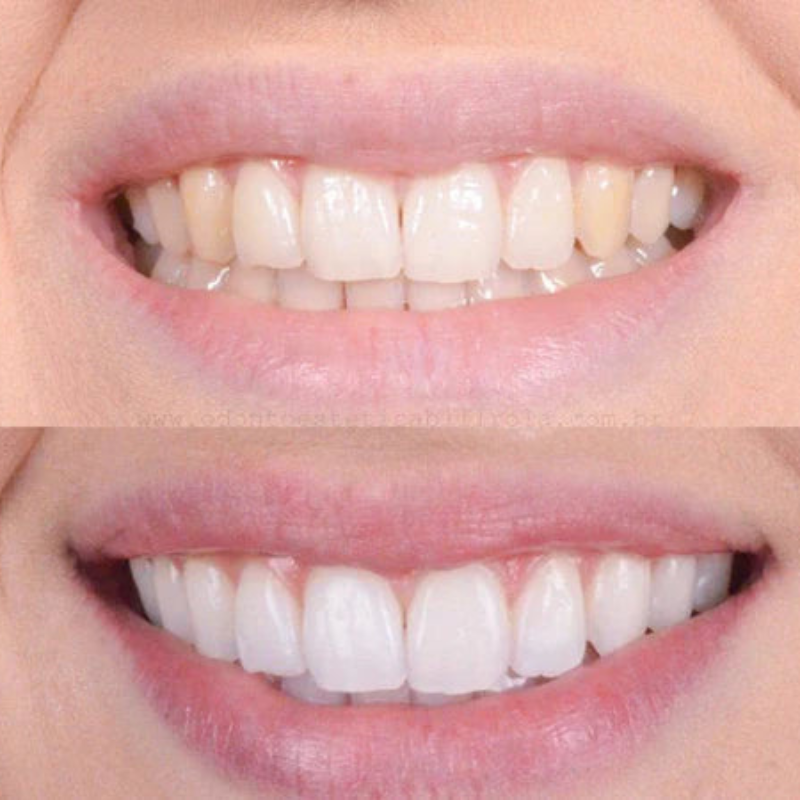 Fast Teeth Whitening To Create A Bright Dazzling Smile Every Day