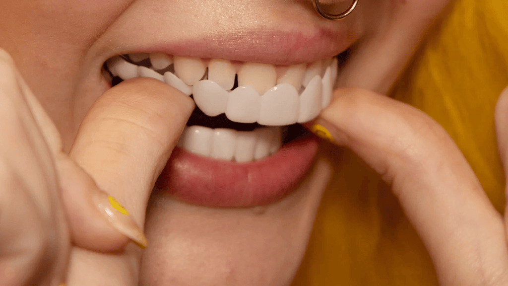 Snap-On Smile fazety pro kompletní horní a dolní zuby