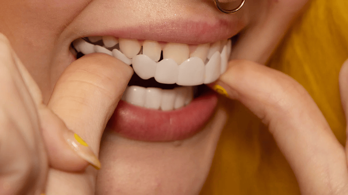 Snap-On Smile fazety pro kompletní horní a dolní zuby