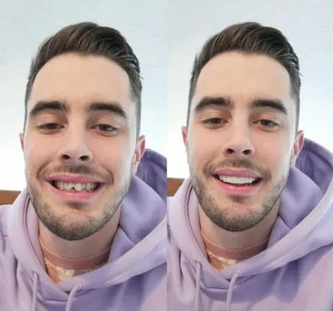 BrightSmile Veneers Set With Upper And Lower Jaw Included | Fervei