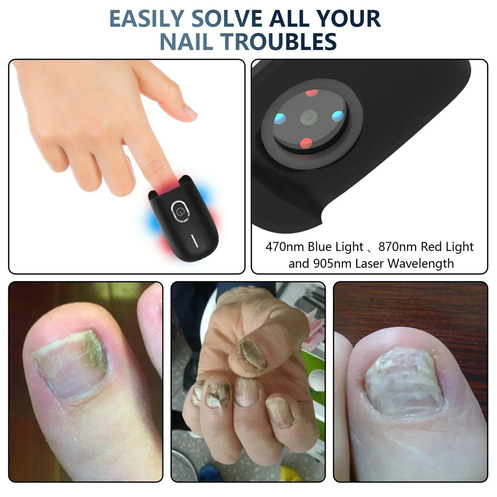 Portable Toenail Fungus Laser Therapy Device With USB Charging