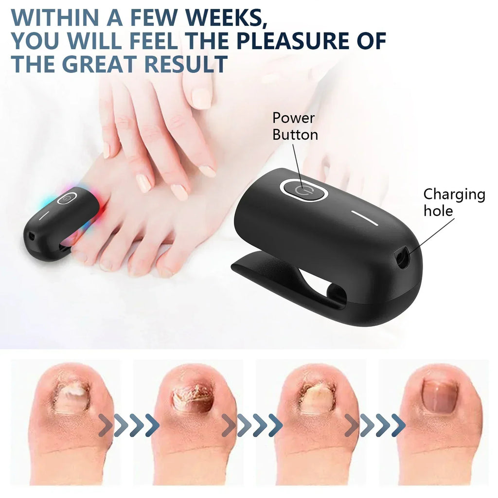 Portable Toenail Fungus Laser Therapy Device With USB Charging