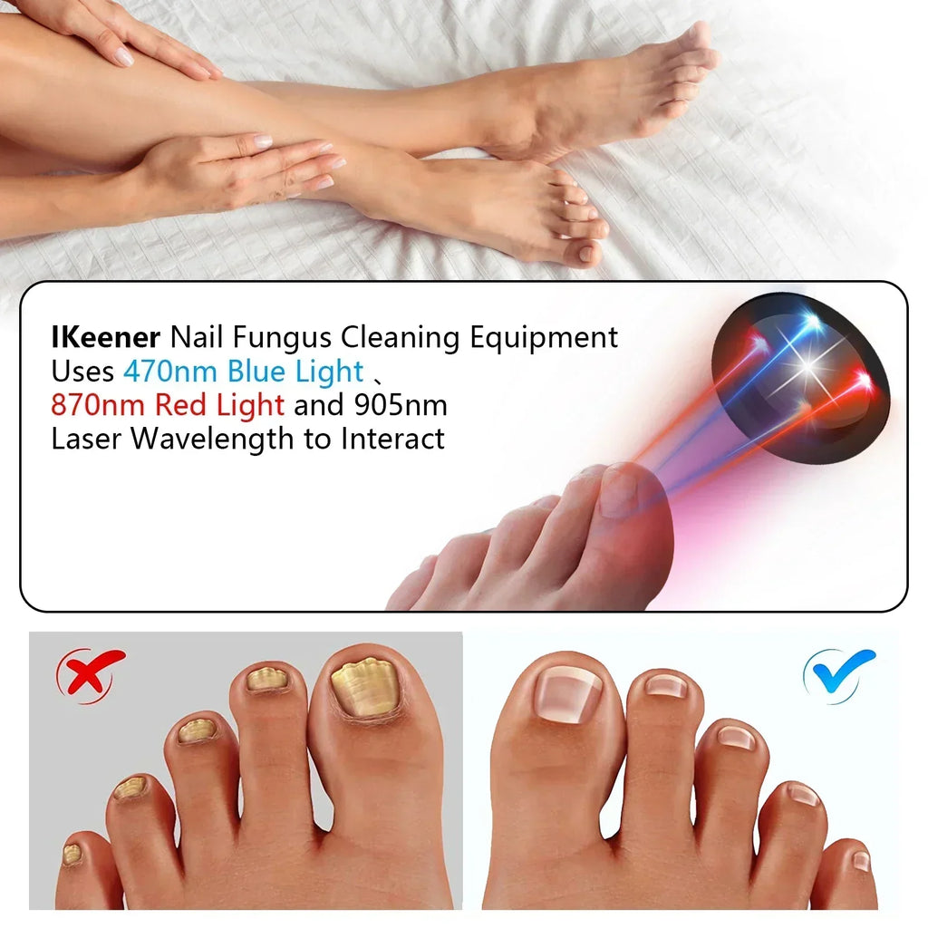 Portable Toenail Fungus Laser Therapy Device With USB Charging