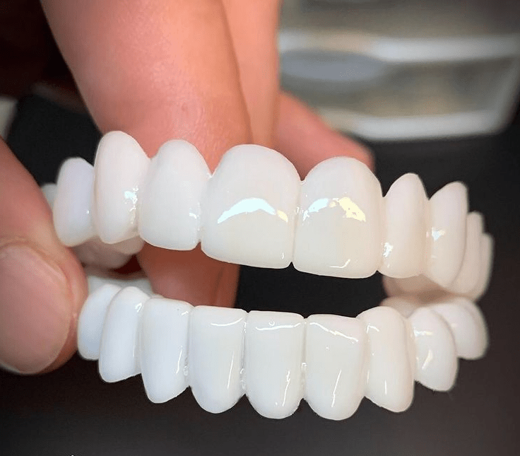 LuminDent Denture With White Dental Lenses For Aesthetic Smile