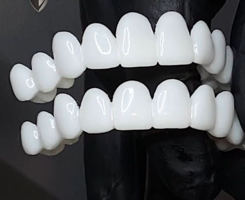 LuminDent Denture With White Dental Lenses For Aesthetic Smile