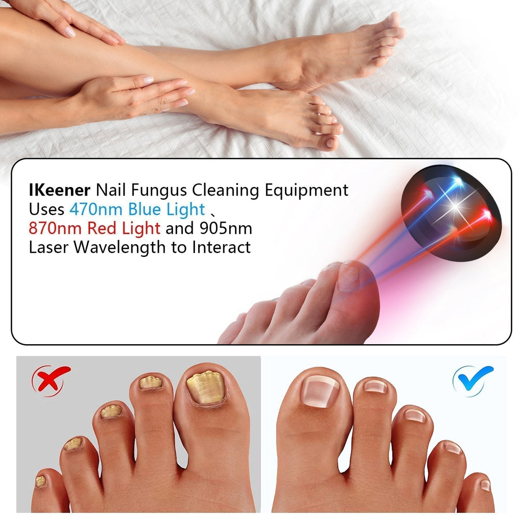 Dispositivo de Terapia a Laser para Fungos nas Unhas em Casa | Fervei