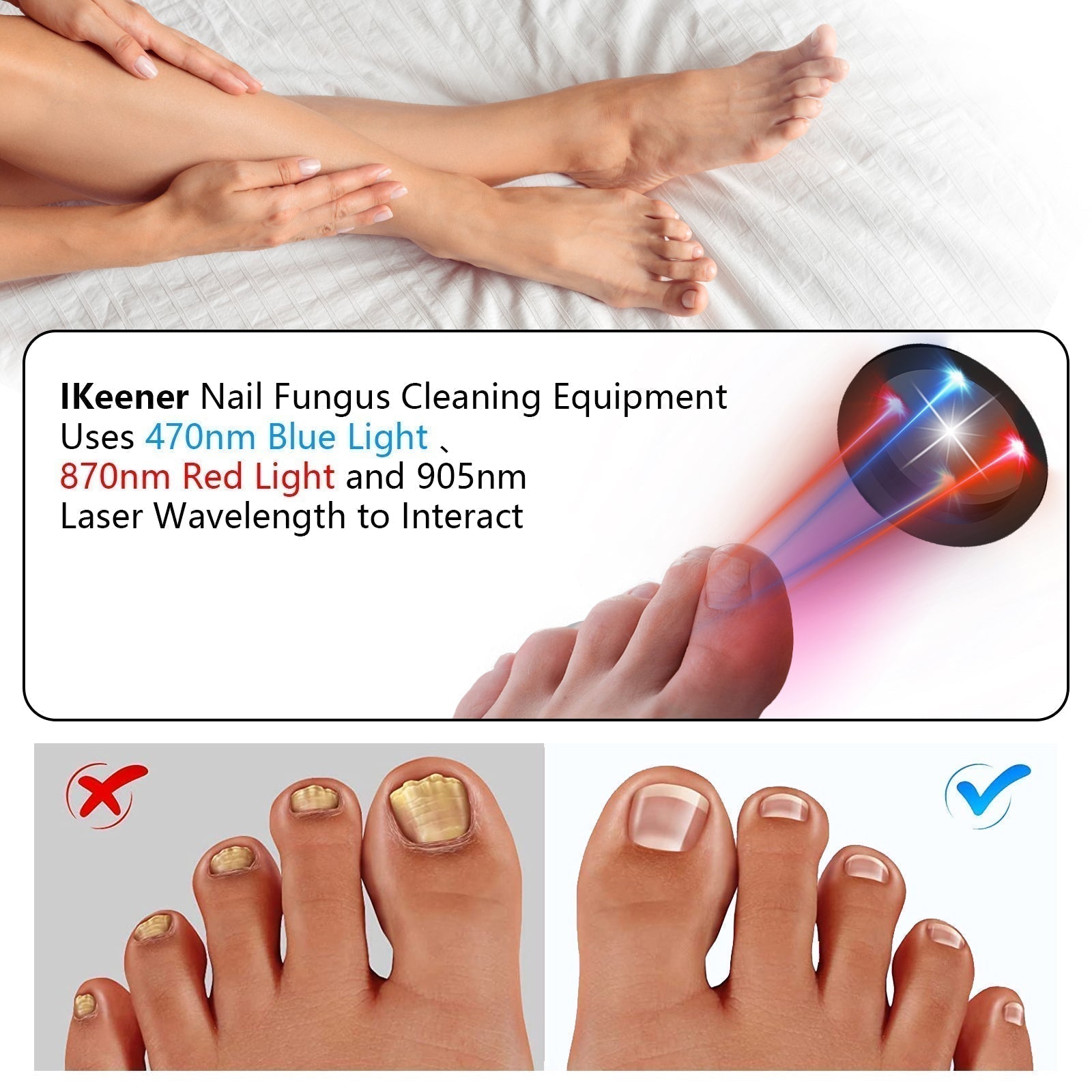 Dispositivo de Terapia a Laser para Fungos nas Unhas em Casa | Fervei