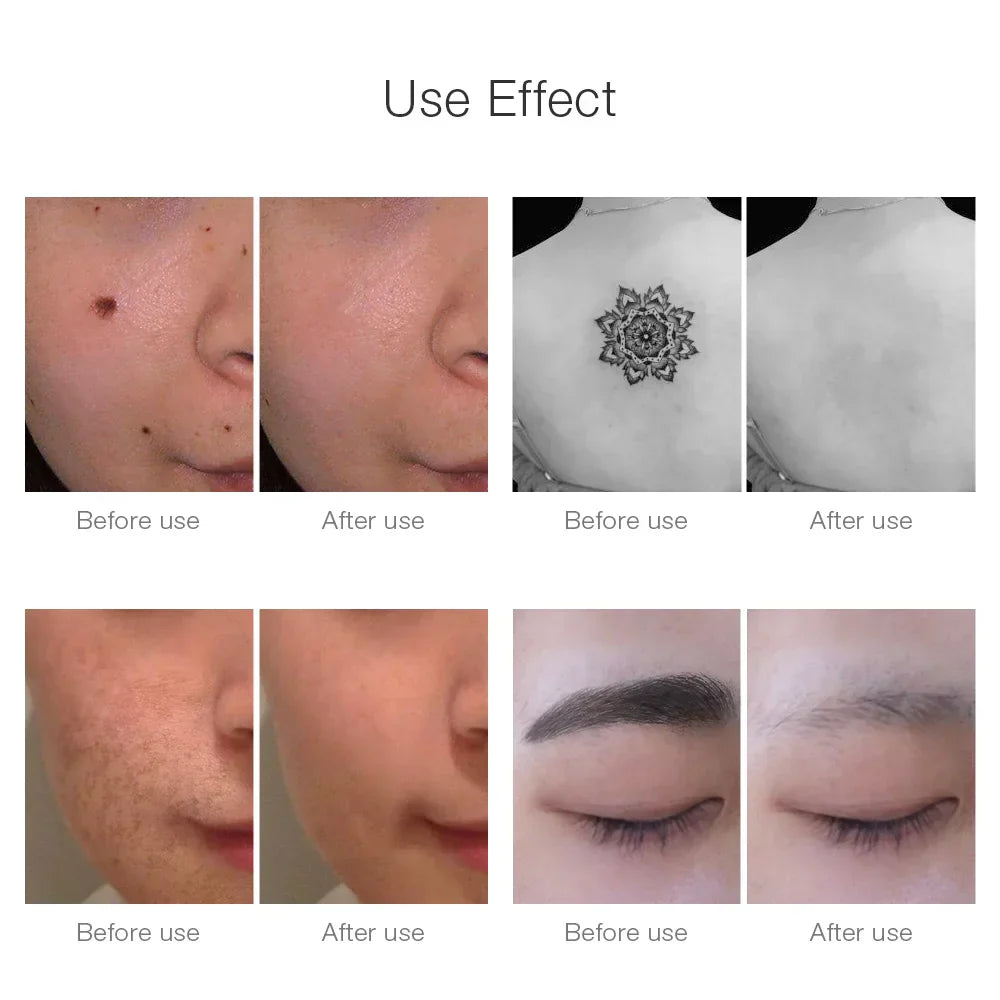 AstraDerm Picosecond Laser Remover for Tattoos and Spots | Fervei